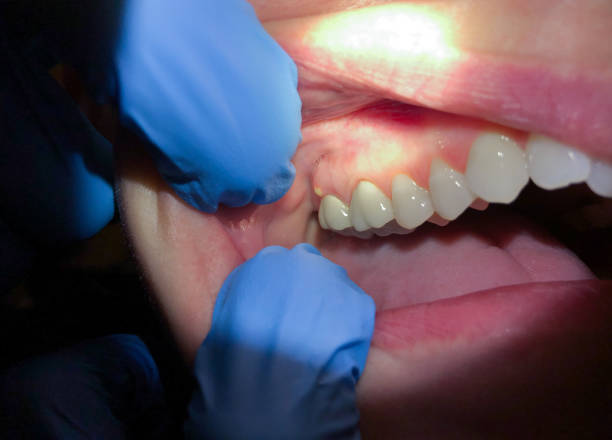 Best Dental Abscess Treatment in Fox Point, WI